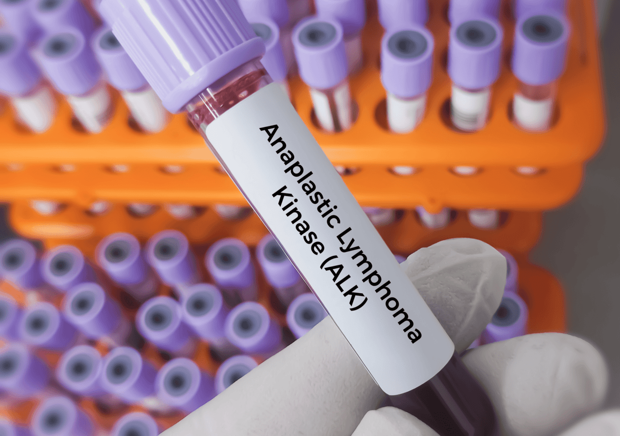 closeup of test tube with label "Anaplastic Lymphoma Kinase (ALK).